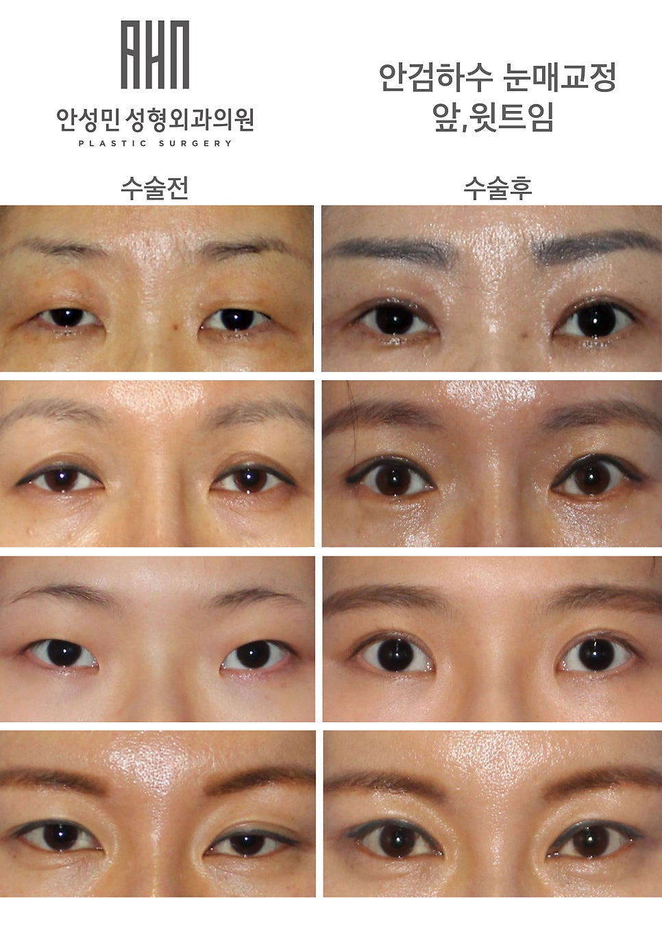 내 눈도 안검하수 일까? 관련 이미지 2