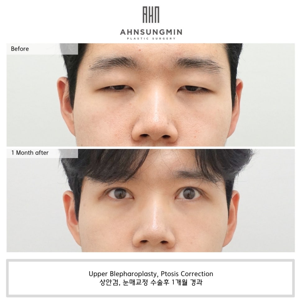 잠실새내역 성형외과 남자 안검하수 눈매교정 전문 관련 이미지 2
