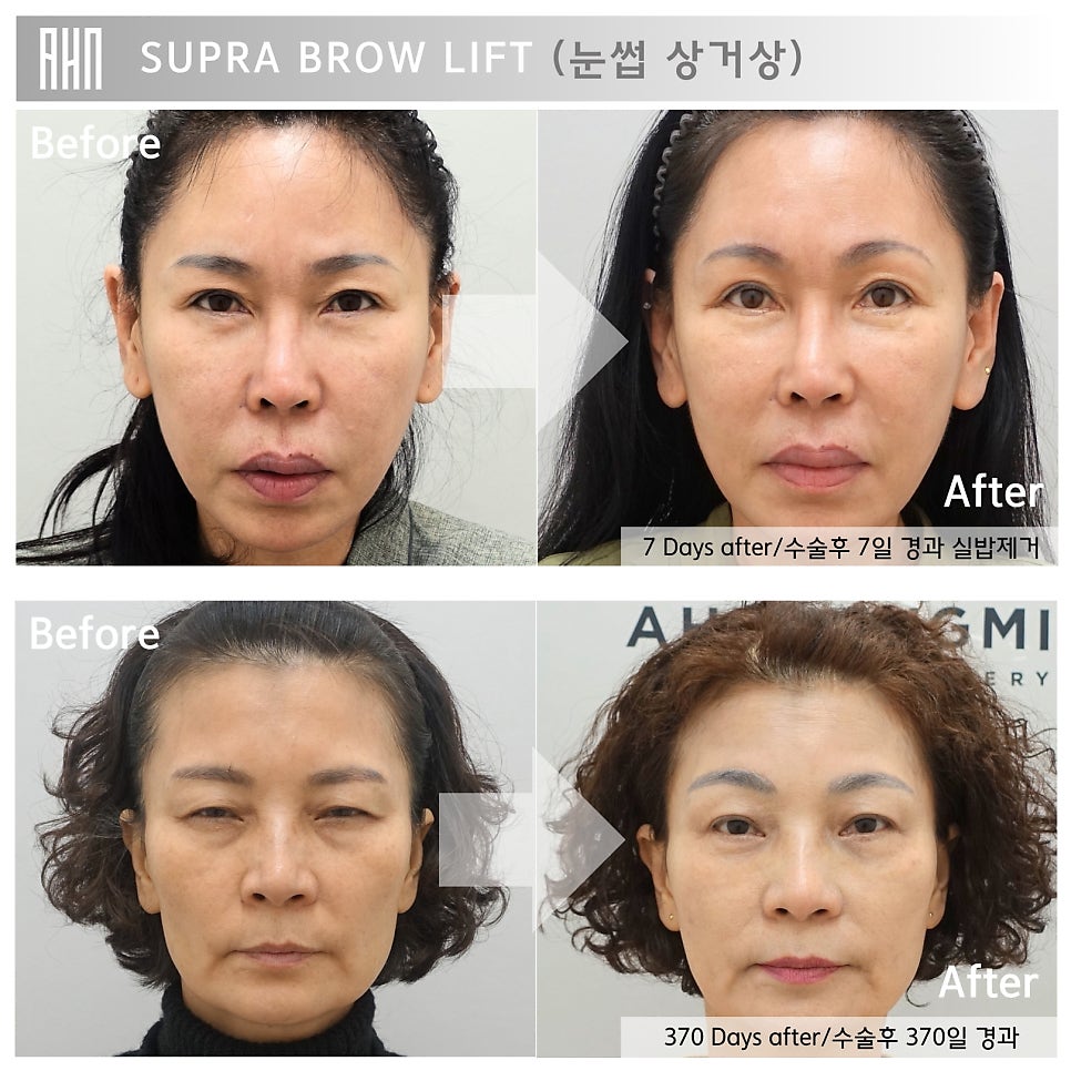 눈썹상거상이 필요한 이유 눈썹하거상의 부작용. 안성민 원장님 관련 이미지 3