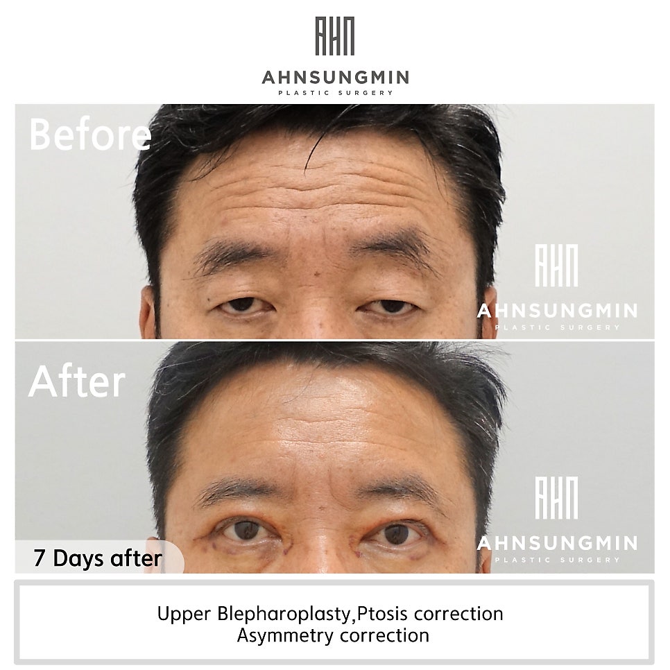 눈매교정 짝짝이 저교정 재수술[성형외과 전문의 안성민 대표원장] 관련 이미지 2