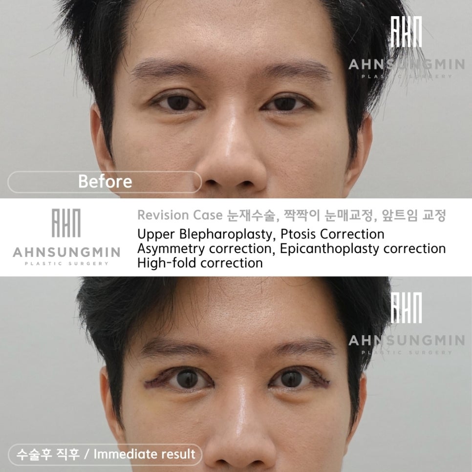 남자 쌍꺼풀 재수술 눈매교정, 짝짝이 교정 잘하는 곳 안성민성형외과 관련 이미지 2