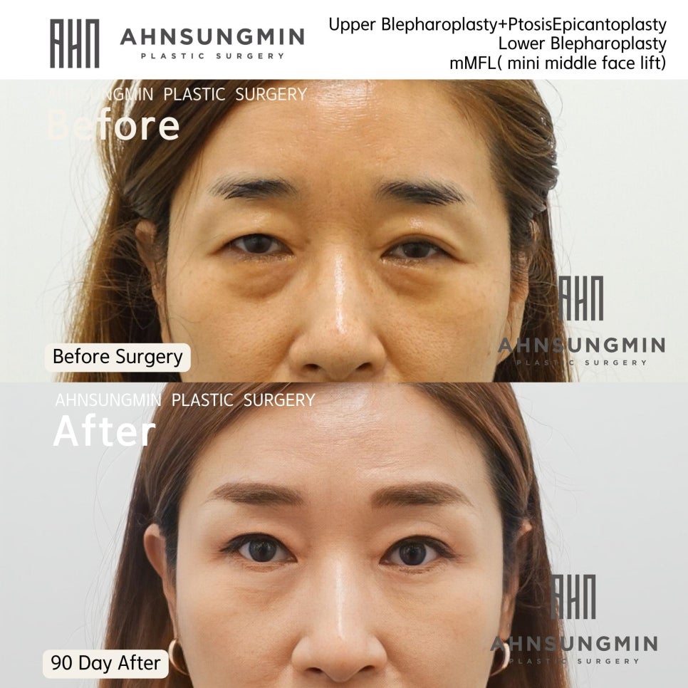 중년의 여성 눈처짐 [상안검 눈매교정,하안검 눈밑지방재배치,미니 중안면거상] 관련 이미지 3