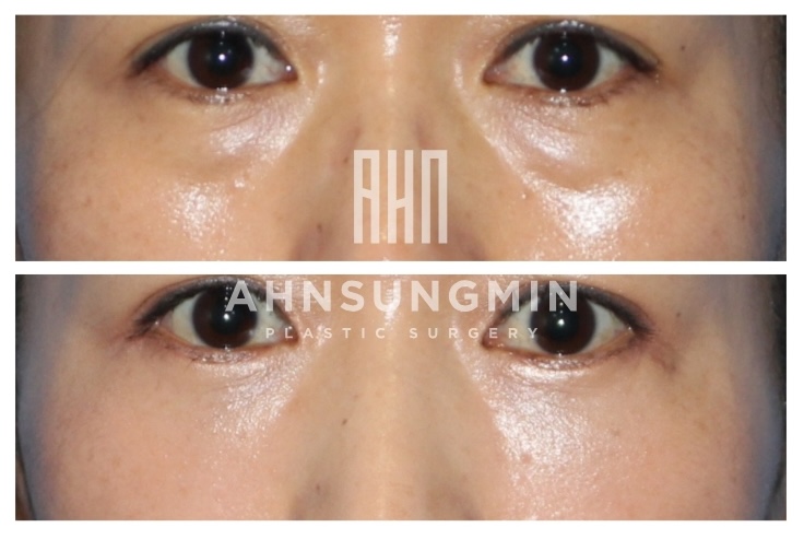 눈밑지방재배치 수술 시 애교 근육을 보존해야 하는 이유 관련 이미지 2