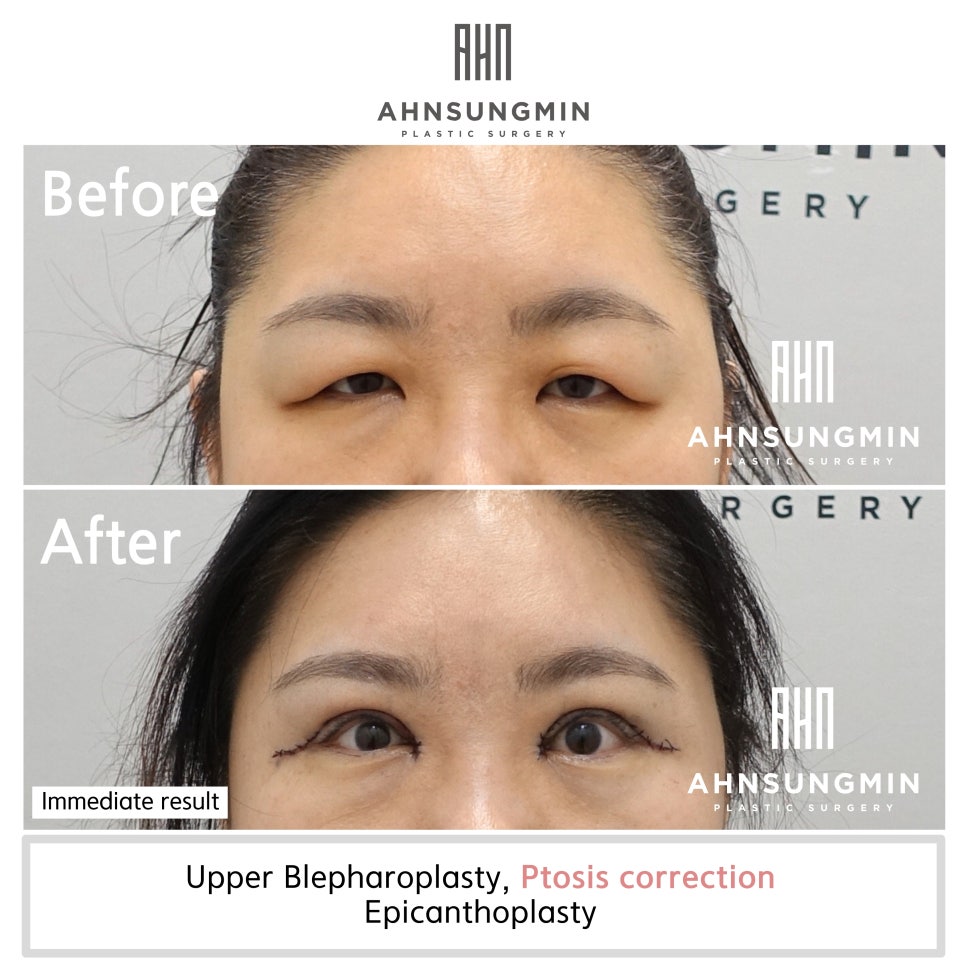 상안검 눈매교정 지방제거 수술 안성민성형외과 관련 이미지 4