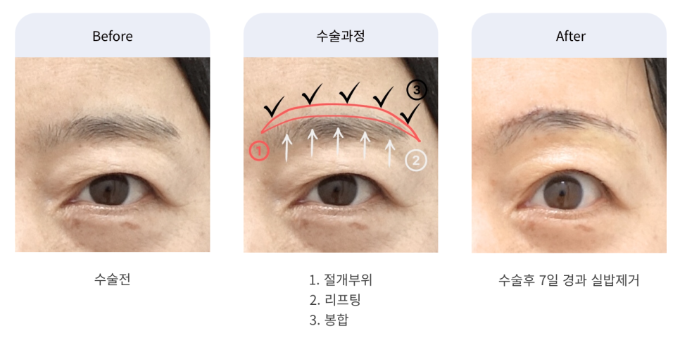 눈썹거상 수술의 장점과 나이대별 회복 과정 관련 이미지 1