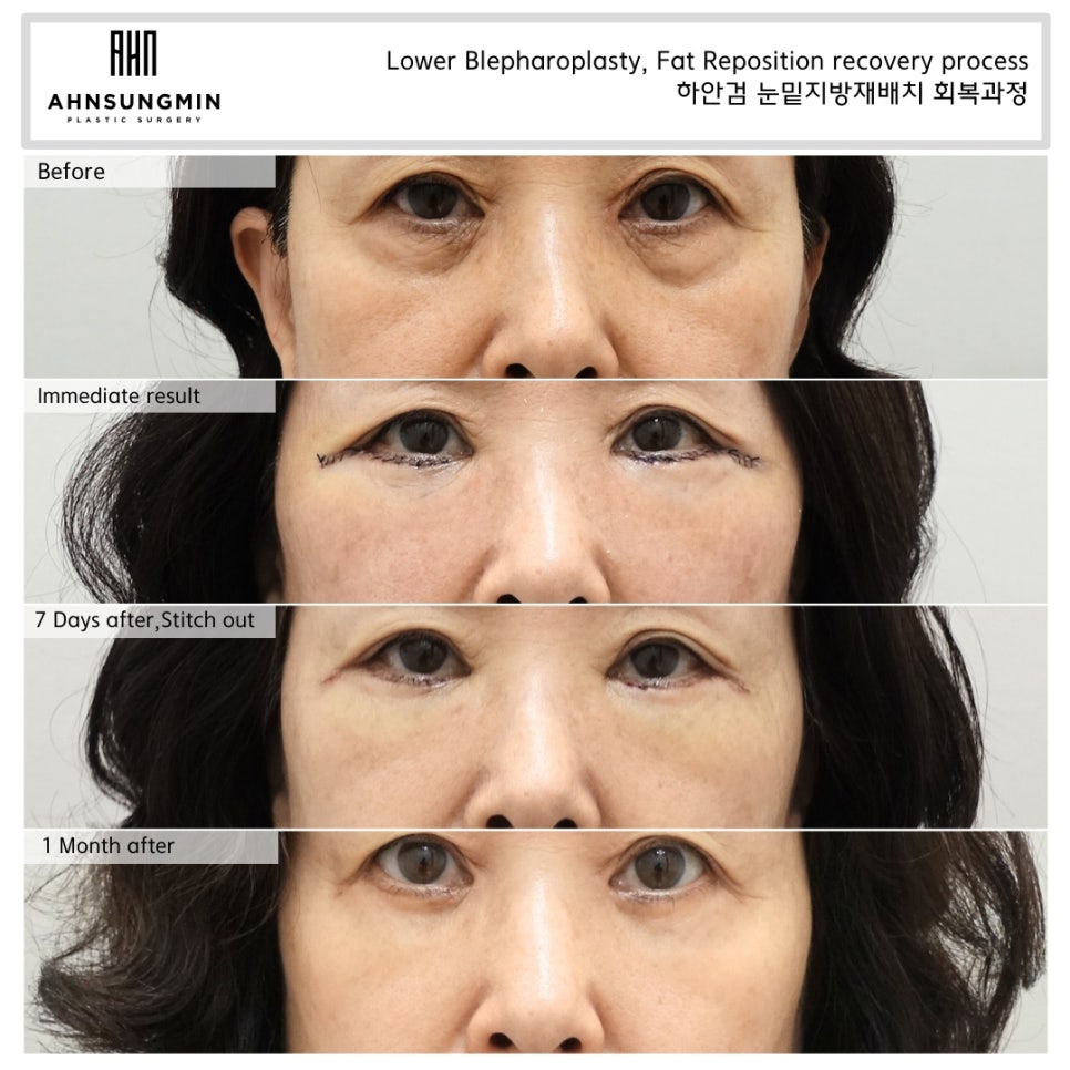 하안검 수술 후 다시 불룩해지는 이유? 재수술 전 반드시 알아야 할 것 관련 이미지 1
