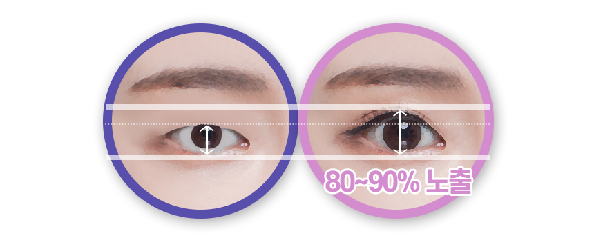 잠실성형외과  오랜 경력의 전문의가 직접 수술합니다. (ft. 눈매교정) 관련 이미지 4