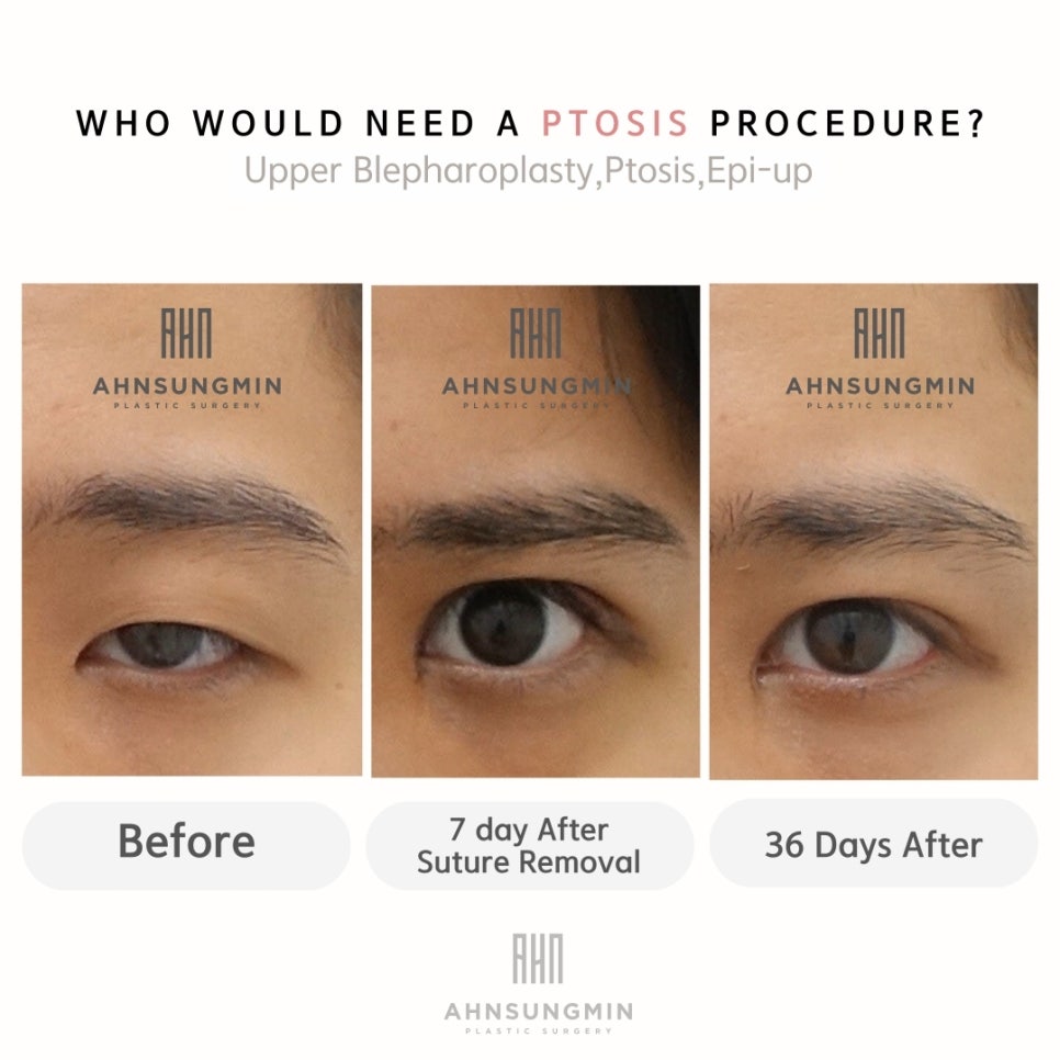 안검하수증세 눈매교정전후 관련 이미지 1