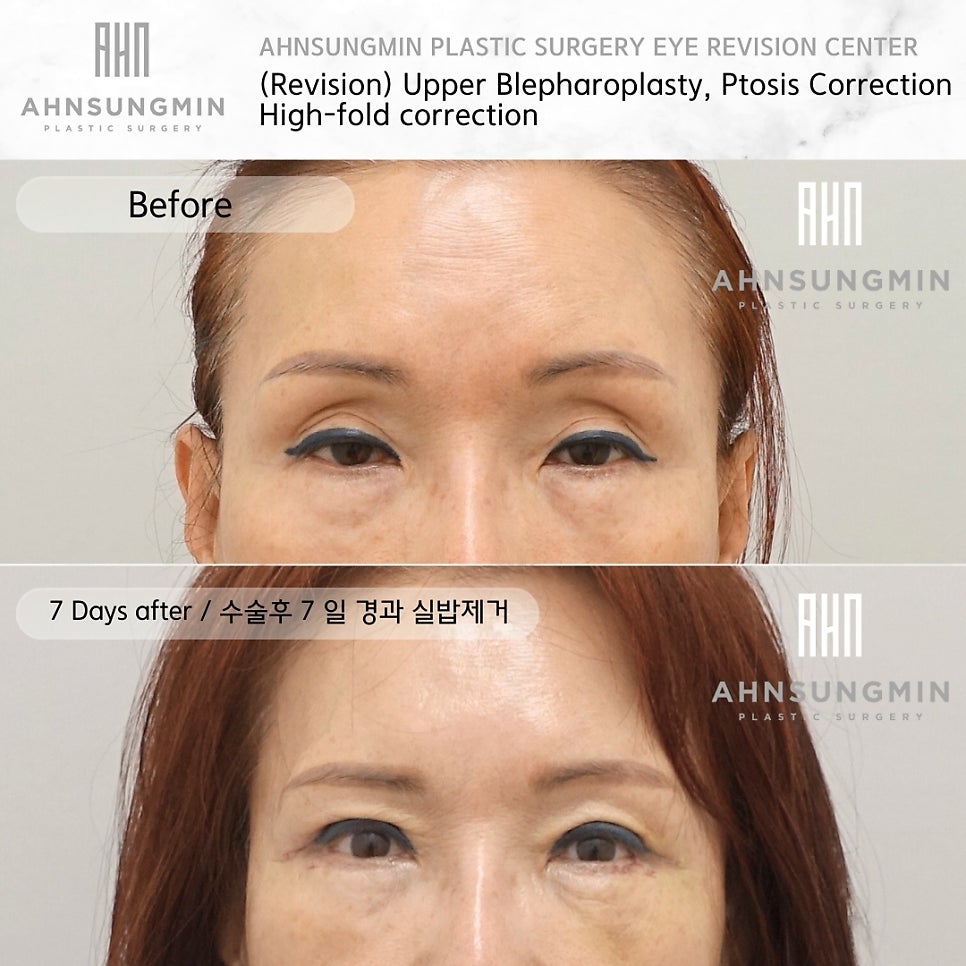 중년 자연스러운 쌍꺼풀 재수술 잘하는 곳, 안성민성형외과 관련 이미지 2