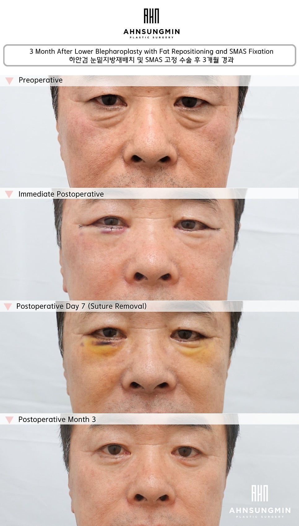 하안검 수술 후 회복 과정, 1주일&middot;1개월&middot;3개월 변화까지 직접 확인해보세요 관련 이미지 2