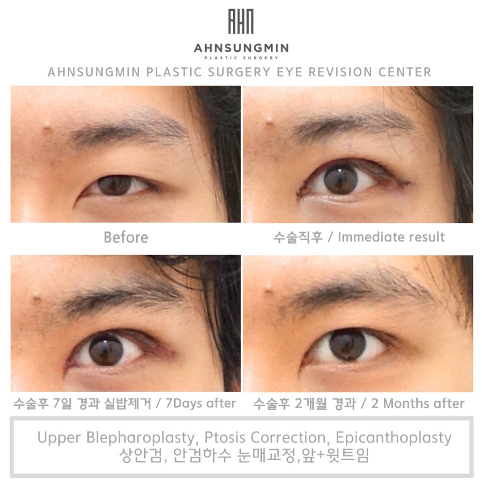 안검하수의 분류, 눈 전문 안성민성형외과 관련 이미지 2