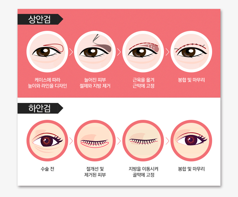 안성민성형외과 상하안검 어떤 효과가 있을가? 관련 이미지 3