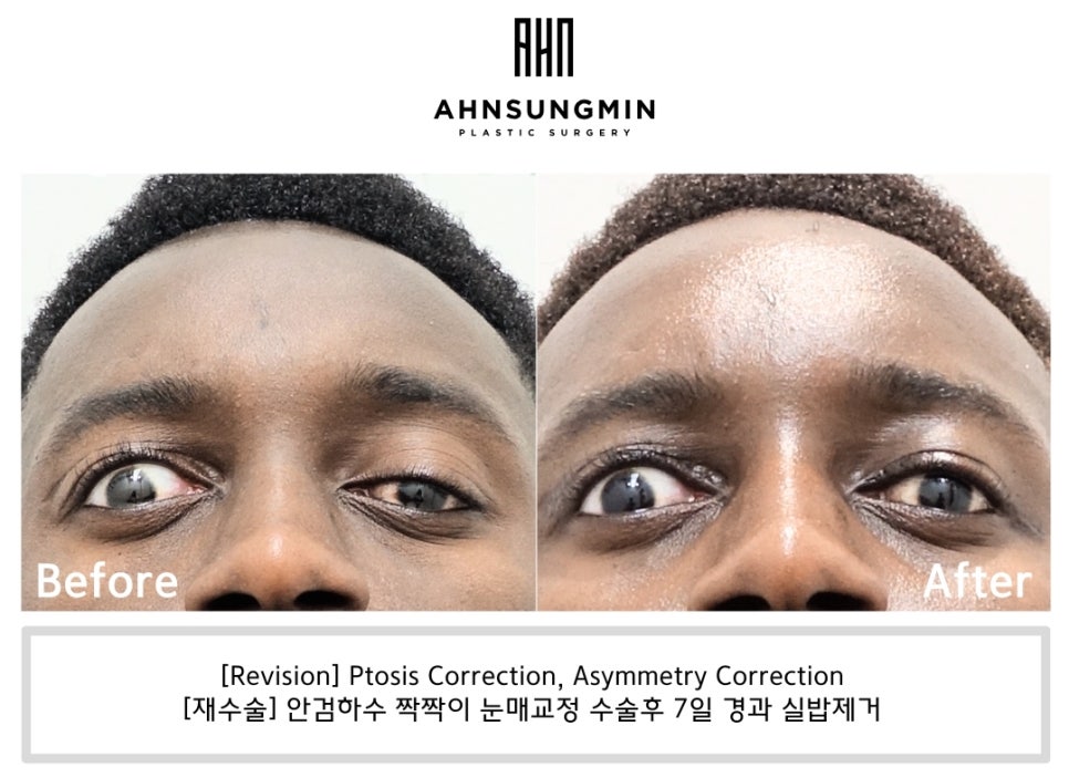 안검하수 짝짝이 교정, 헤링스법칙  [성형외과 전문의 안성민] 관련 이미지 3