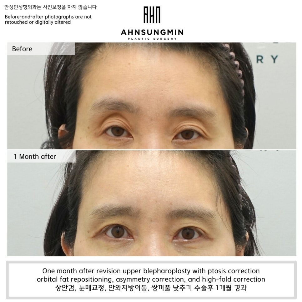 안검하수 짝짝이로 인해 눈꺼풀 꺼짐이 악화된 경우 관련 이미지 1