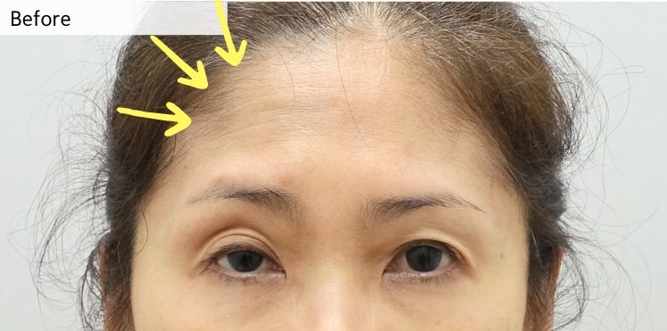 [재수술] 안검하수 짝짝이 교정을 한쪽 눈만 할 수 없는 이유 관련 이미지 2