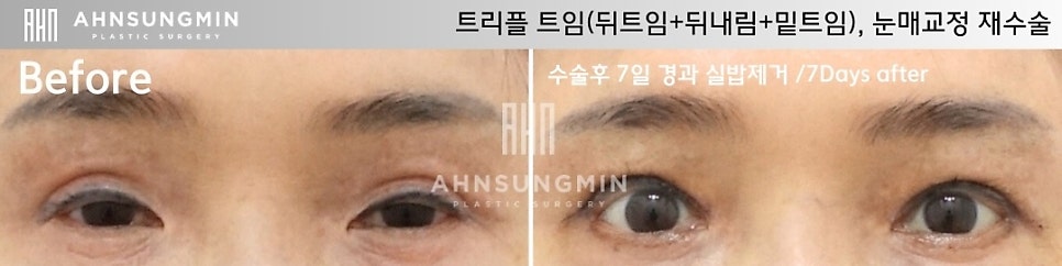 트리플 트임 뒤트임,뒤내림,밑내림 어떻게 다를까? 관련 이미지 4