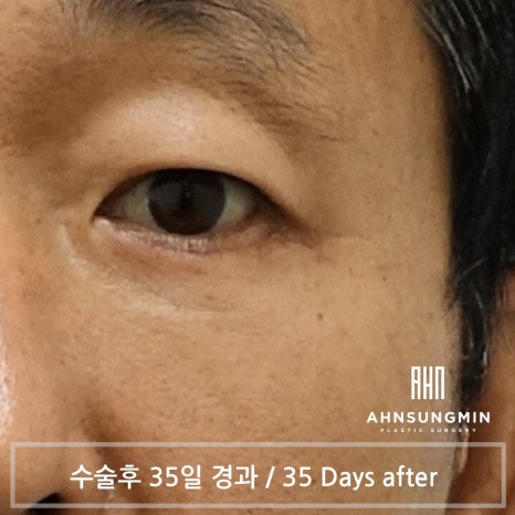 중년 남자 눈 밑 수술 후회 없이 안전하게 잘하려면 [성형외과 전문의 안성민] 관련 이미지 6
