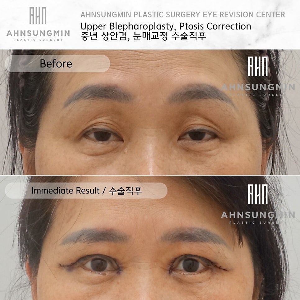 중년 여성의 상안검 수술 주의사항과 혈압관리 관련 이미지 2