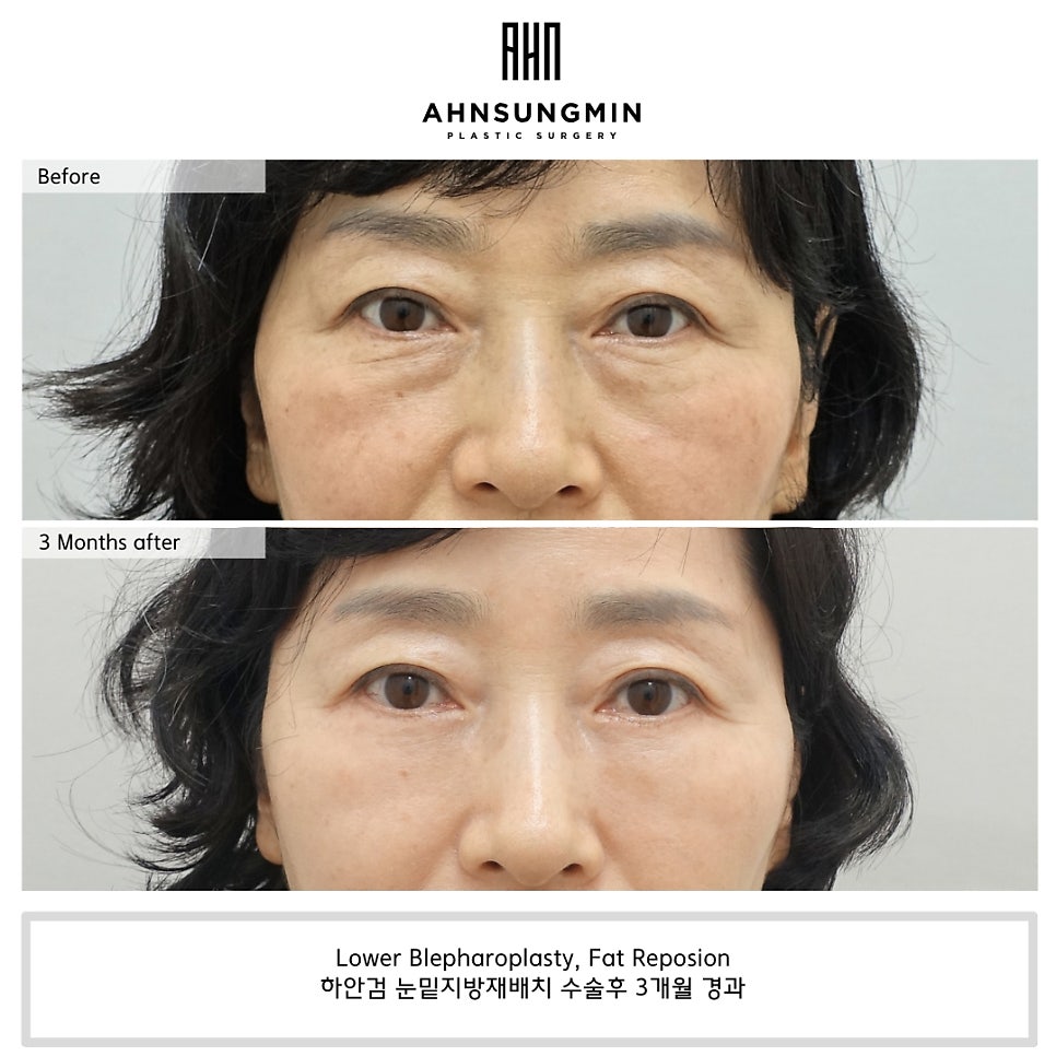 눈 밑주름 해결 50대 여성 하안검 수술 후 3개월 경과 관련 이미지 1