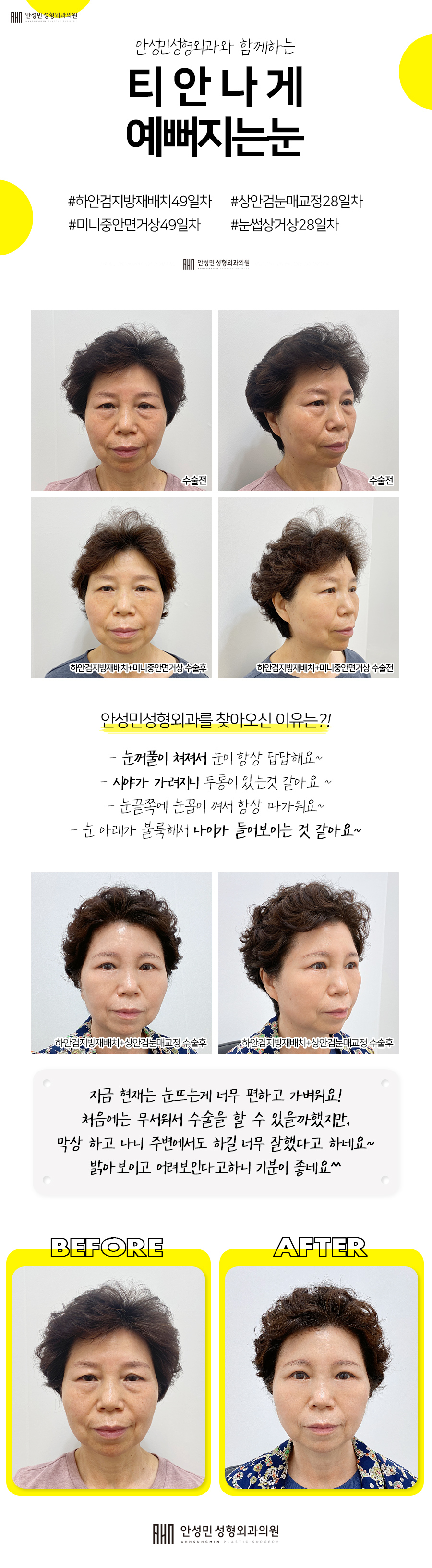 [잠실동성형외과] 눈성형은 역시, 안성민성형외과 관련 이미지 1