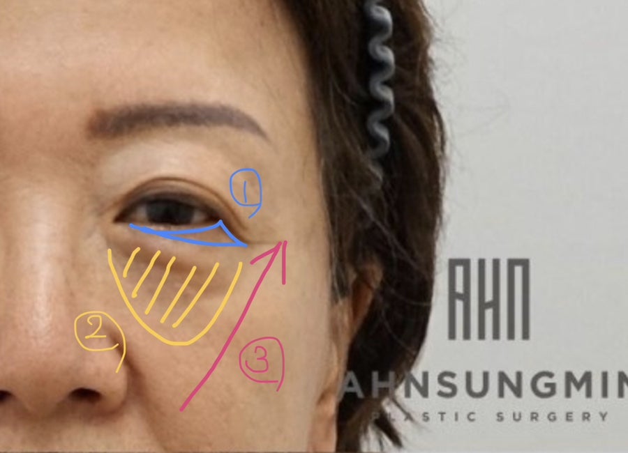 중년의 눈성형 하안검 수술방법 안성민원장님 관련 이미지 4