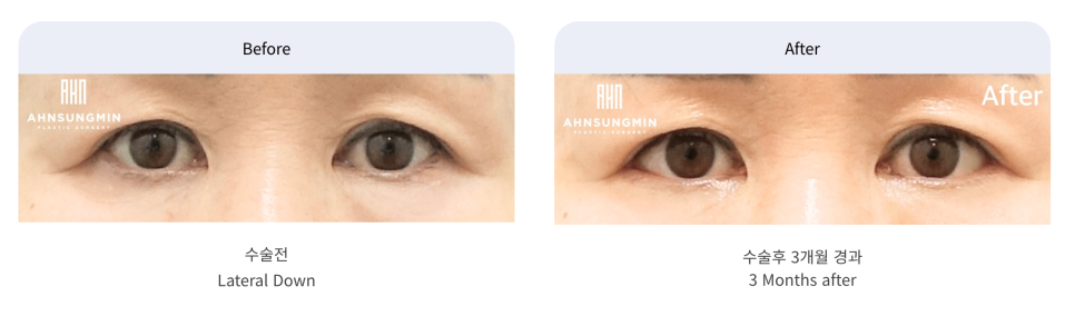 트임 성형의 모든 것 뒤트임, 뒷내림, 밑트임 관련 이미지 5