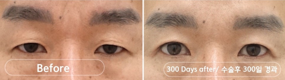 나이대별 상안검 수술, 처진 눈꺼풀을 개선하다 관련 이미지 4