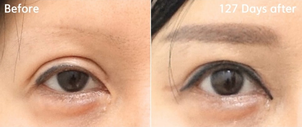 소세지눈 쌍꺼풀 풀기 재수술로 해결 관련 이미지 9