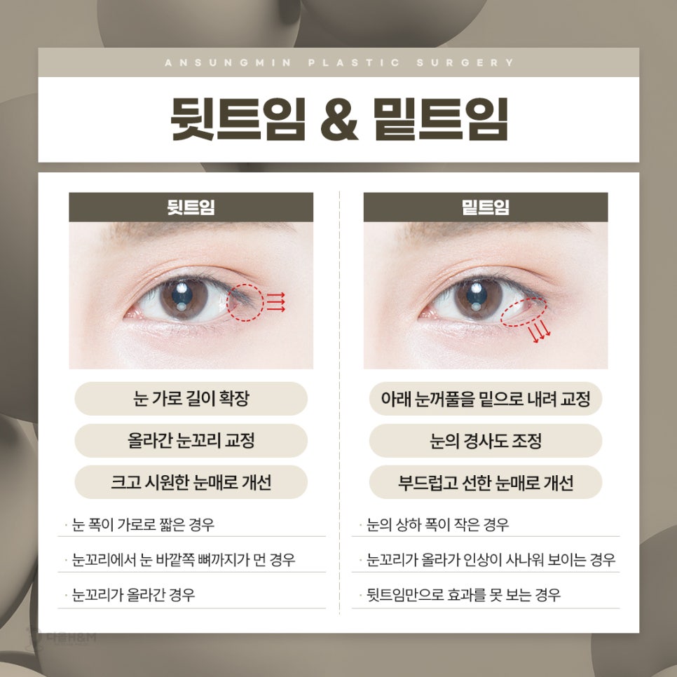 선명한 눈매는 서울트임수술 안성민 성형외과 관련 이미지 4