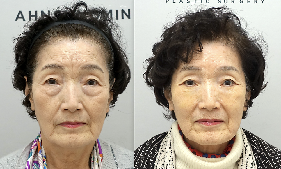 노년의 하안검 수술 주의점, 70대 여성 하안검 눈밑지방재배치 첫수술 관련 이미지 3