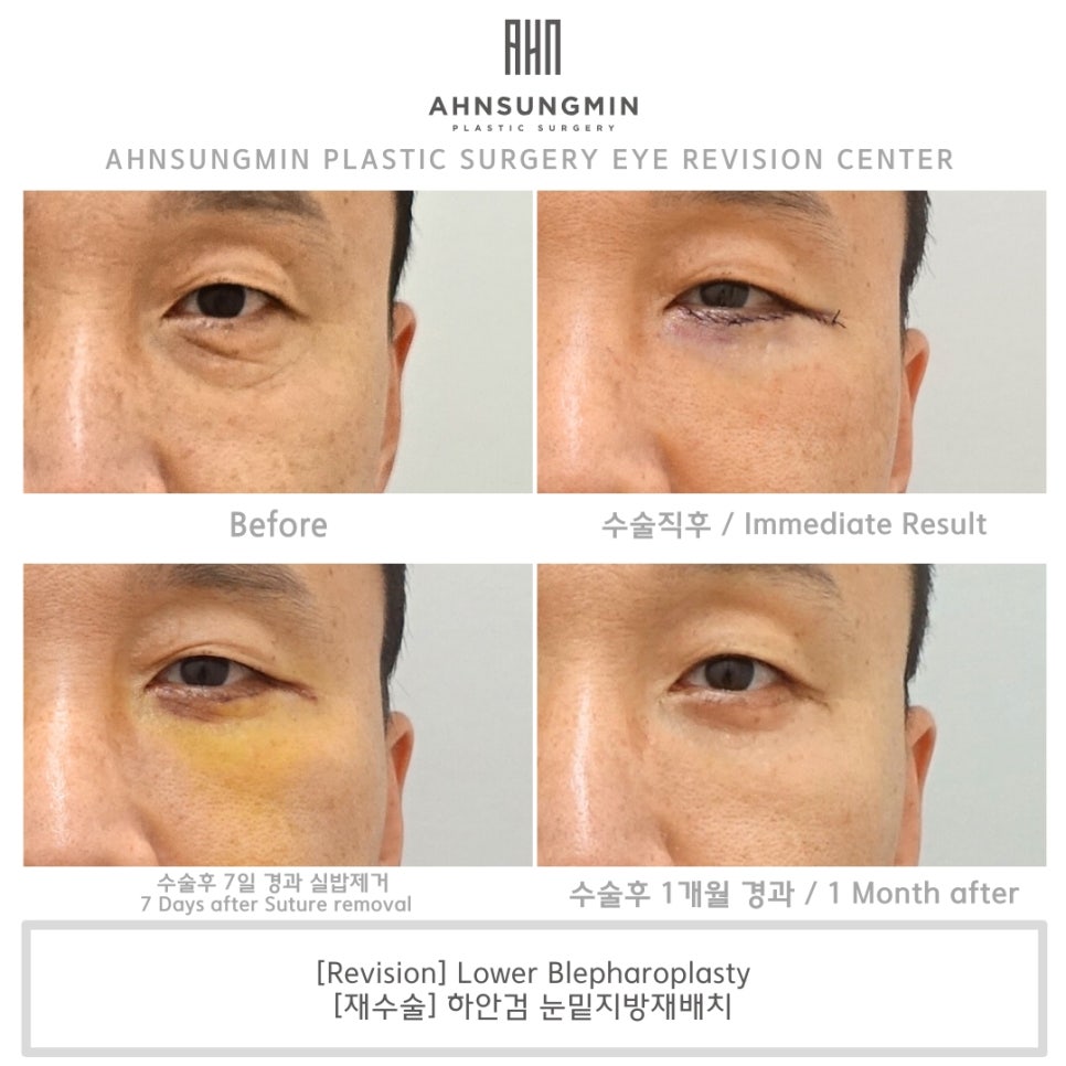 중년 하안검, 눈 밑 지방재배치 재수술 근본적인 원인을 해결하다. 관련 이미지 3