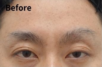 쌍꺼풀 재수술 후 눈은 언제 자연스러워질까? (Day 1부터 6개월 변화) 관련 이미지 2