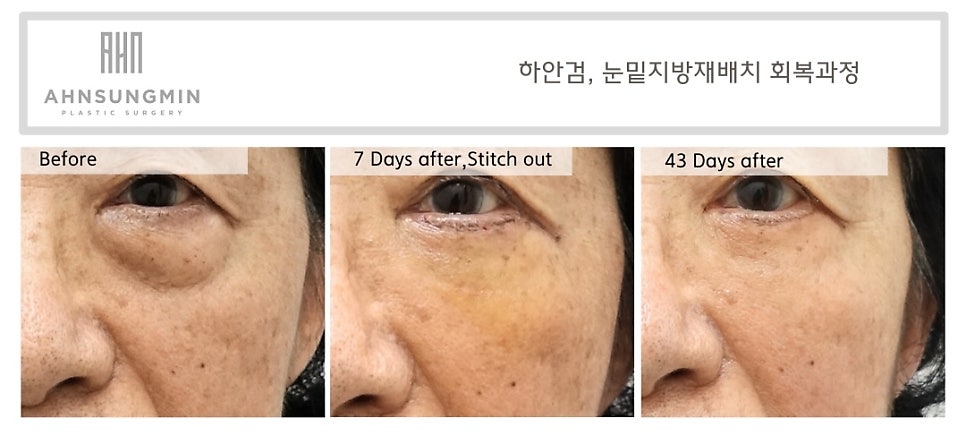 하안검 수술 시 중안면 근육 거상의 중요성 [성형외과 전문의 안성민] 관련 이미지 4