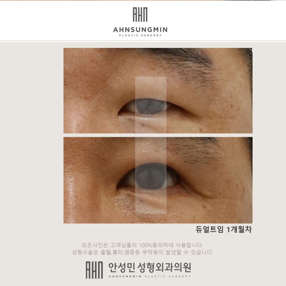 안성민듀얼트임[뒷트임+뒷내림] 관련 이미지 3