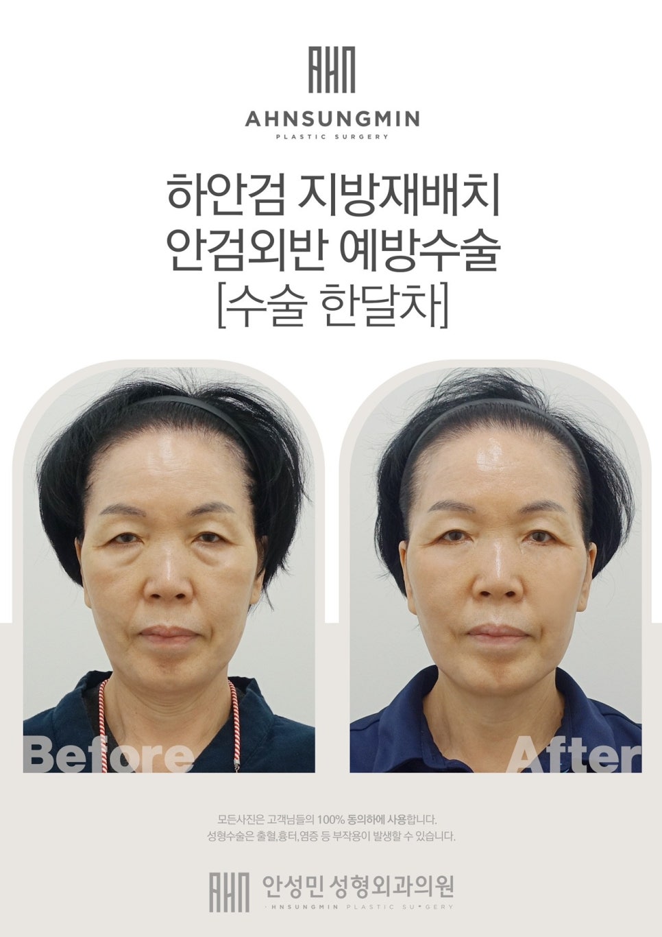 [안성민 성형외과]하안검지방재배치 고객님의 두번째수술 관련 이미지 1