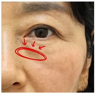 하안검 지방재배치 재수술, 정말 가능한가요? 관련 이미지 4