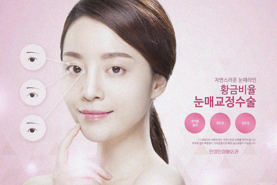 눈매교정 관련 이미지 9