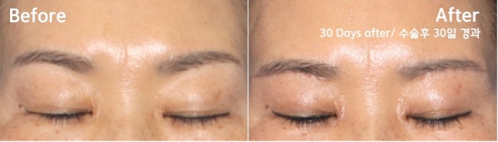 눈썹하거상 후 눈썹 모양, 눈썹하거상 부작용을 겪지 않으려면?잠실성형외과 관련 이미지 3