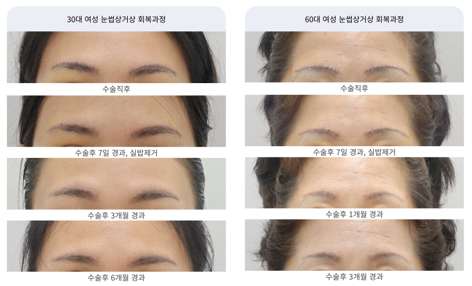 눈썹 거상 수술 흉터와 회복 과정 관련 이미지 8