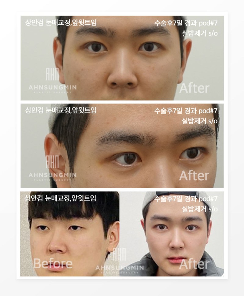 눈꺼풀처짐 노안이미지로 걱정이라면 관련 이미지 5