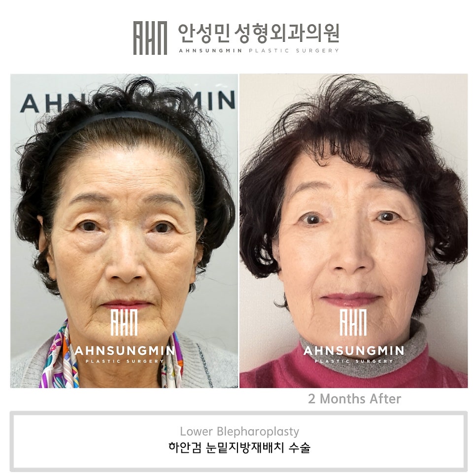 70대 여성 눈 밑 하안검 수술 회복 리얼 후기 관련 이미지 9