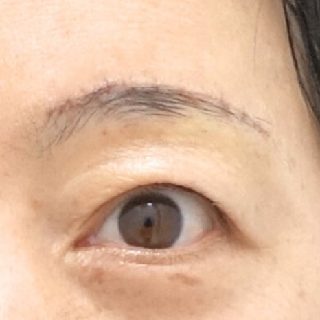 눈썹 상거상 수술이 필요한 이유와 눈썹 하거상 수술의 부작용 관련 이미지 5