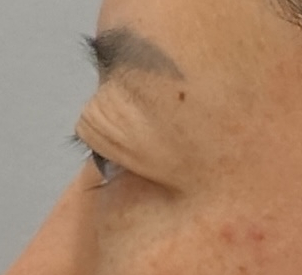 돌출눈 쌍꺼풀 수술이 가능할까? 관련 이미지 3