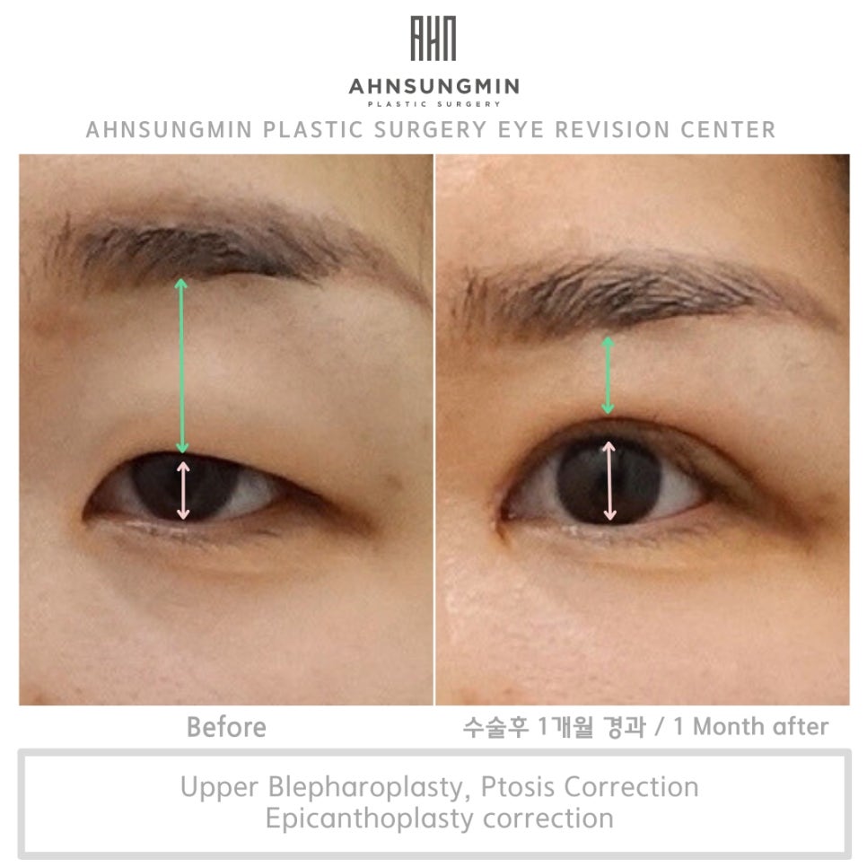 눈두덩이가 무겁고 답답해요. 내눈도 혹시 안검하수? 관련 이미지 2