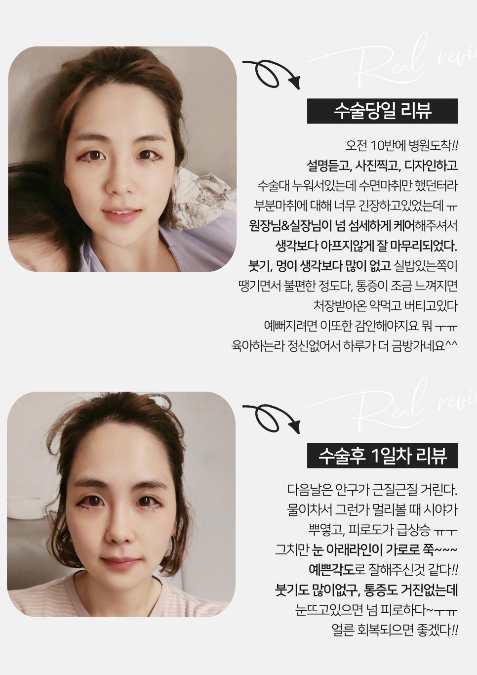 [잠실동성형외과] 듀얼트임 고객님의 리얼후기! 성형후기! 뚜렷한 눈매를 원한다면? 잠실 안성민성형외과! 관련 이미지 2