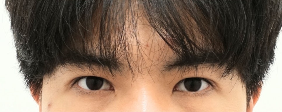 나이대별 상안검 수술 전후, 성형외과전문의 안성민 관련 이미지 4