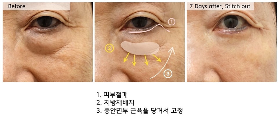 70대 여성 하안검 노화 과정에 따른 하안검 수술 주의점 관련 이미지 3
