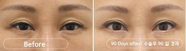 트리플 트임 뒤트임,뒤내림,밑내림 어떻게 다를까? 관련 이미지 2