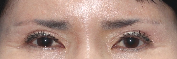 눈썹상거상이 필요한 이유 눈썹하거상의 부작용. 안성민 원장님 관련 이미지 2