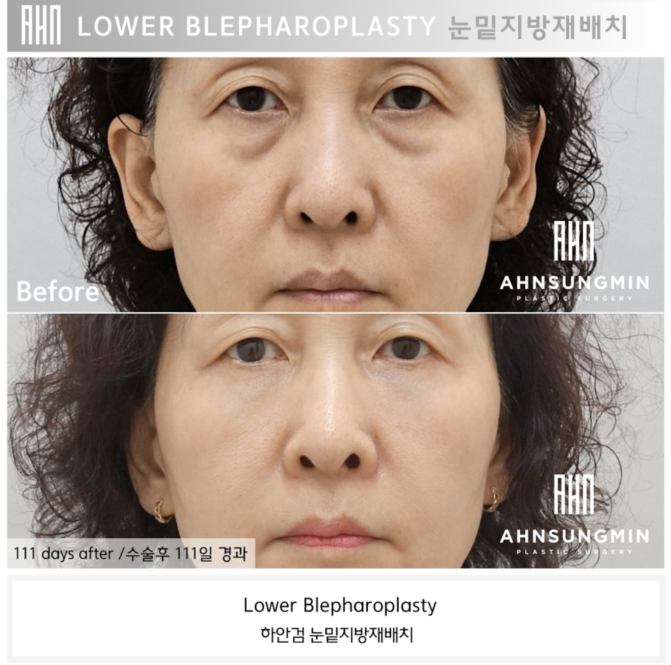 불룩한 눈 밑 지방, 해결할 수 있을까? 관련 이미지 5